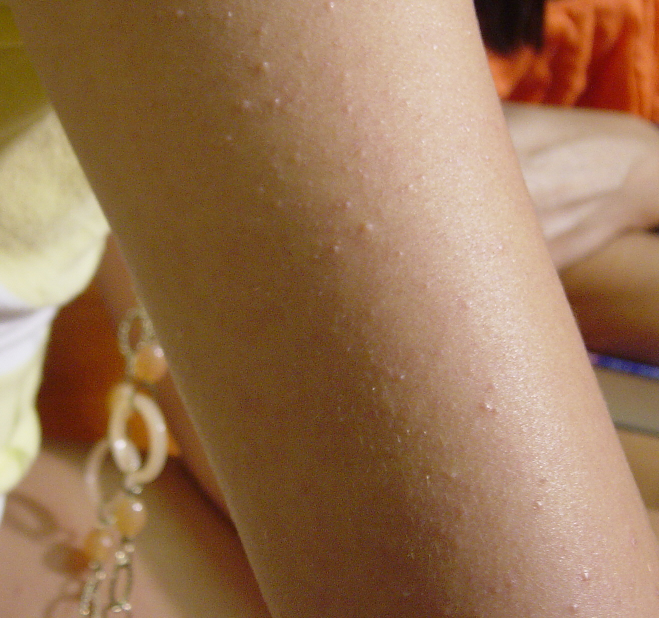 Keratosis Pilaris K P Is A Skin Condition Effecting Roughly Half Of The Population And Resulting In A Goose Flesh Appearance Or Dry Scaly Bumps Covering The Arms Thighs Buttocks Varying Degrees Of