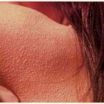Keratosis Pilaris most often effects the upper arms, thighs and buttocks but can also be found on the face and other areas of the body. 